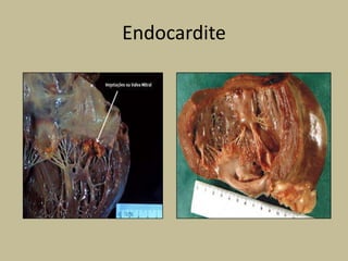 Endocardite
 