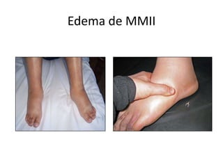 Edema de MMII
 