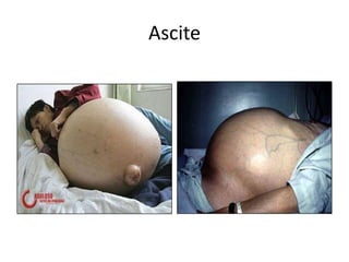 Ascite
 