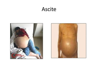 Ascite
 