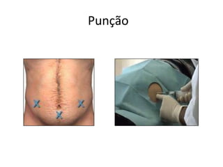 Punção
 