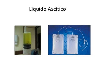Líquido Ascítico
 