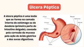 A úlcera péptica é uma lesão
que se forma na camada
interna do estômago ou do
duodeno (primeira parte do
intestino delgado), causada
pela corrosão da mucosa
pela ação do ácido gástrico
e dos sucos digestivos.
Úlcera Péptica
 