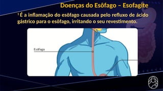 Doenças do Esôfago – Esofagite
1
É a inflamação do esôfago causada pelo refluxo de ácido
gástrico para o esôfago, irritando o seu revestimento.
 