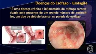 Doenças do Esôfago – Esofagite
3
É uma doença crônica e inflamatória do esôfago caracte-
rizada pela presença de um grande número de eosinófi-
los, um tipo de glóbulo branco, na parede do esôfago.
 