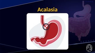 Acalasia
 