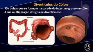 São bolsas que se formam na parede do intestino grosso ou cólon.
A sua multiplicação designa-se diverticulose.
Divertículos do Cólon
 
