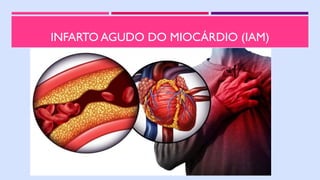 INFARTO AGUDO DO MIOCÁRDIO (IAM)
 