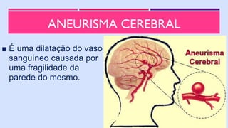 ANEURISMA CEREBRAL
■ É uma dilatação do vaso
sanguíneo causada por
uma fragilidade da
parede do mesmo.
 