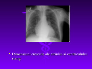 • Dimensiuni crescute ale atriului si ventriculului
stang

 
