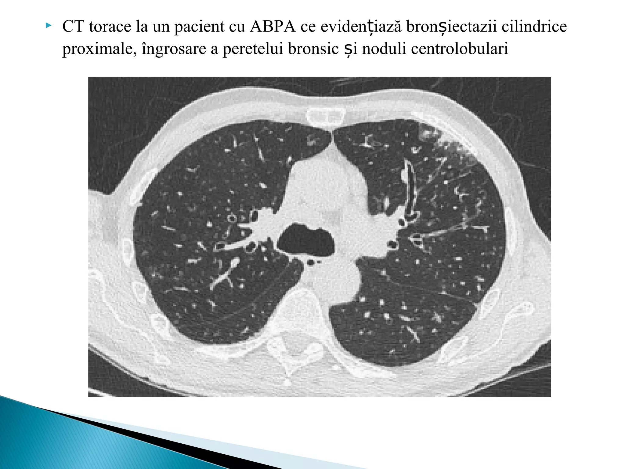  CT torace la un pacient cu ABPA ce eviden iazăț bronșiectazii cilindrice
proximale, îngrosare a peretelui bronsic iș noduli centrolobulari 
 