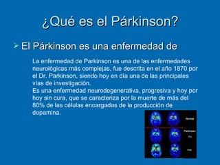 ¿Qué es el Párkinson? El Párkinson es una enfermedad de La enfermedad de Parkinson es una de las enfermedades neurológicas más complejas, fue descrita en el año 1870 por el Dr. Parkinson, siendo hoy en día una de las principales vías de investigación.  Es una enfermedad neurodegenerativa, progresiva y hoy por hoy sin cura, que se caracteriza por la muerte de más del 80% de las células encargadas de la producción de dopamina. 