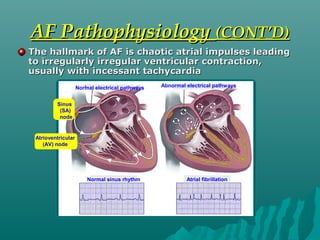 AF PathophysiologyAF Pathophysiology (CONT’D)(CONT’D)
The hallmark of AF is chaotic atrial impulses leadingThe hallmark of AF is chaotic atrial impulses leading
to irregularly irregular ventricular contraction,to irregularly irregular ventricular contraction,
usually with incessant tachycardiausually with incessant tachycardia
Normal electrical pathways Abnormal electrical pathways
Normal sinus rhythm Atrial fibrillation
Sinus
(SA)
node
Atrioventricular
(AV) node
 
