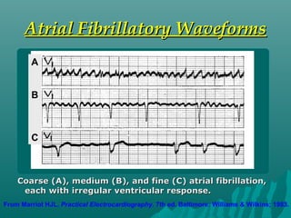 From Marriot HJL. Practical Electrocardiography. 7th ed. Baltimore: Williams & Wilkins; 1983.
Atrial Fibrillatory WaveformsAtrial Fibrillatory Waveforms
Coarse (A), medium (B), and fine (C) atrial fibrillation,Coarse (A), medium (B), and fine (C) atrial fibrillation,
each with irregular ventricular response.each with irregular ventricular response.
A
B
C
 