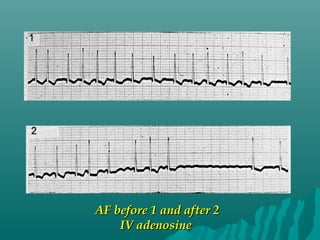 AF before 1 and after 2AF before 1 and after 2
IV adenosineIV adenosine
 
