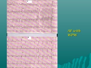 AF withAF with
WPWWPW
 