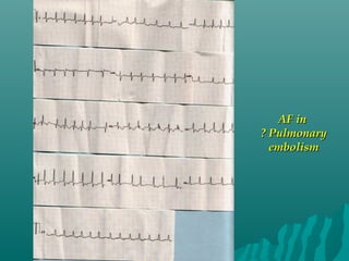 AF inAF in
? Pulmonary? Pulmonary
embolismembolism
 