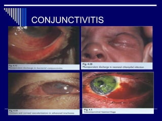 CONJUNCTIVITIS
 