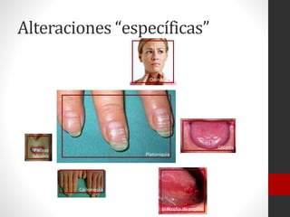 Alteraciones “específicas”
Odinofagia

Glositis

Fisuras
labiales

Platoniquia

Coiloniquia

Atrofia de papilas

 