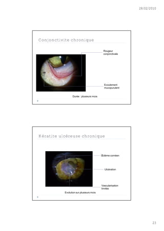28/02/2010




Conjonctivite chronique

                                            Rougeur
                                            conjonctivale




                                             Ecoulement
                                             mucopurulent


                  Dur‚e : plusieurs mois




Kératite ulcéreuse chronique



                                           Œd•me corn‚en




                                             Ulc‚ration




                                           Vascularisation
                                           limit‚e
           Evolution sur plusieurs mois




                                                                    23
 