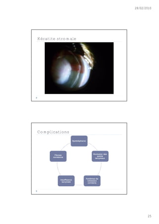 28/02/2010




Kératite stromale




Complications
                            Symblépharon




                                                 Occlusion des
        Fibrose
                                                    points
       cornéenne
                                                  lacrymaux




                                           Fantômes de
             Insuffisance
                                            vaisseaux
               lacrymale
                                            cornéens




                                                                        25
 