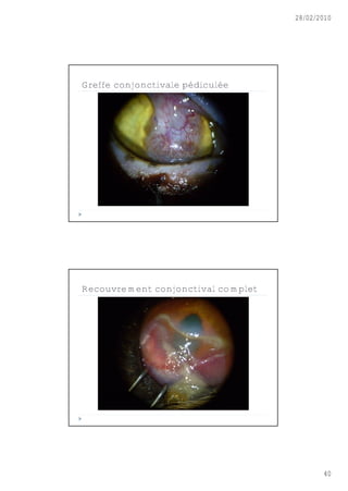 28/02/2010




Greffe conjonctivale pédiculée




Recouvrement conjonctival complet




                                           40
 