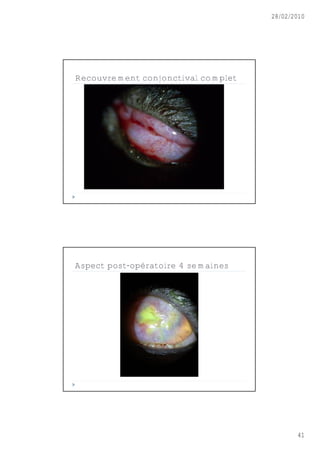28/02/2010




Recouvrement conjonctival complet




Aspect post-opératoire 4 semaines




                                           41
 