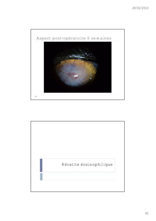 28/02/2010




Aspect post-opératoire 6 semaines




           Kératite éosinophilique




                                            42
 