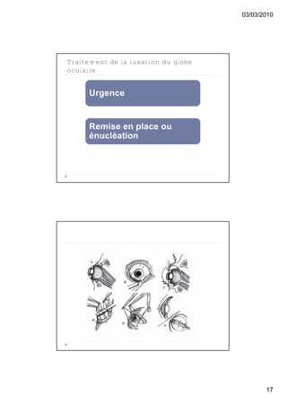 03/03/2010




Traitement de la luxation du globe
oculaire


      Urgence


      Remise en place ou
      énucléation




                                            17
 