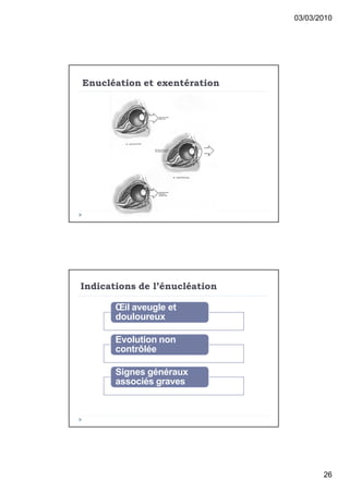03/03/2010




Enucl€ation et exent€ration




Indications de l’€nucl€ation

       Œil aveugle et
       douloureux

       Evolution non
       contr…l€e

       Signes g€n€raux
       associ€s graves




                                      26
 