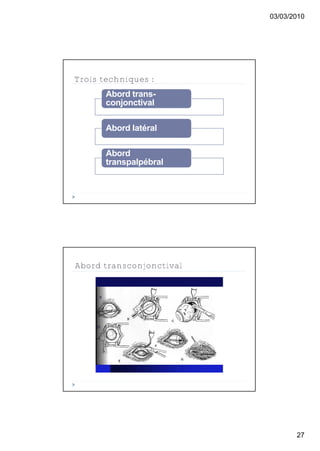 03/03/2010




Trois techniques :
       Abord trans-
       conjonctival

       Abord latéral

       Abord
       transpalpébral




Abord transconjonctival




                                 27
 
