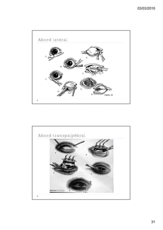 03/03/2010




Abord latéral




Abord transpalpébral




                              31
 