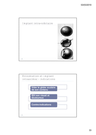 03/03/2010




Implant intra-orbitaire




Eviscération et implant
intrascléral : indications


       Vider le globe oculaire
       de son contenu

       Œil non visuel et
       douloureux


       Contre-indications




                                        33
 