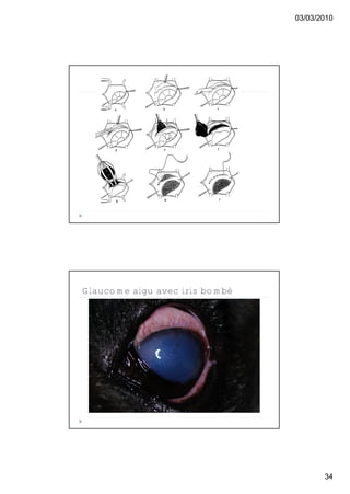 03/03/2010




Glaucome aigu avec iris bombé




                                       34
 