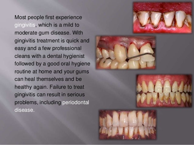 Affect of smoking on periodontium