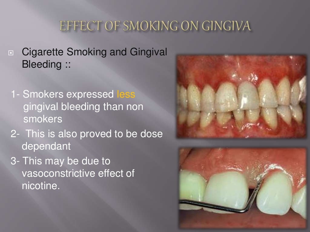 Affect of smoking on periodontium