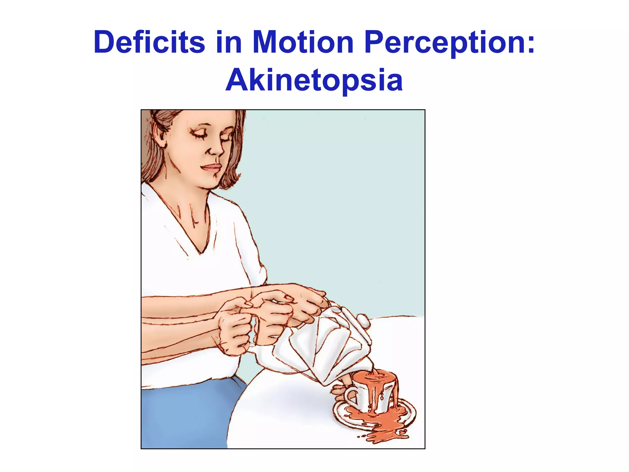 Deficits in Motion Perception:
Akinetopsia
 
