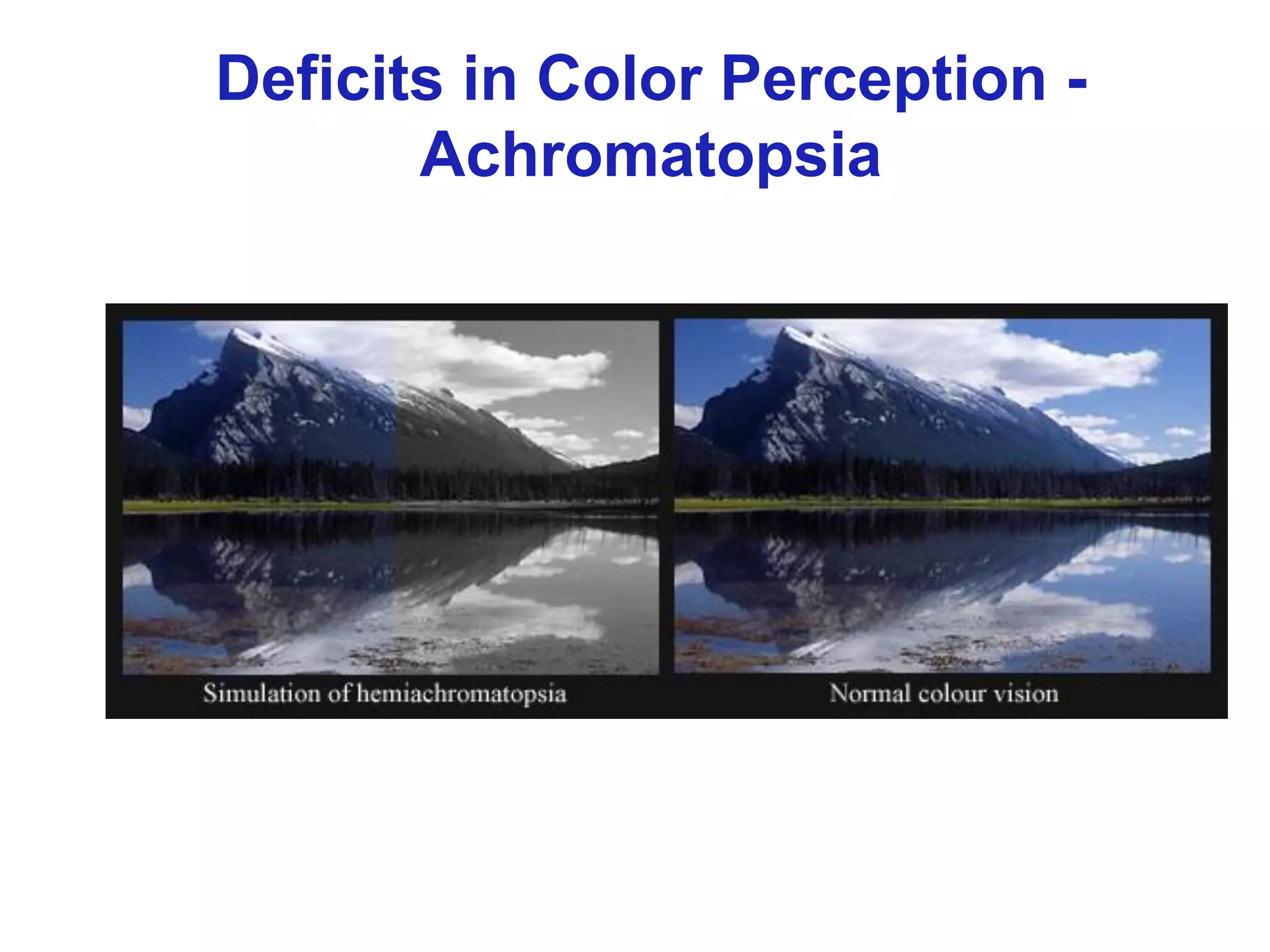 Deficits in Color Perception -
Achromatopsia
 