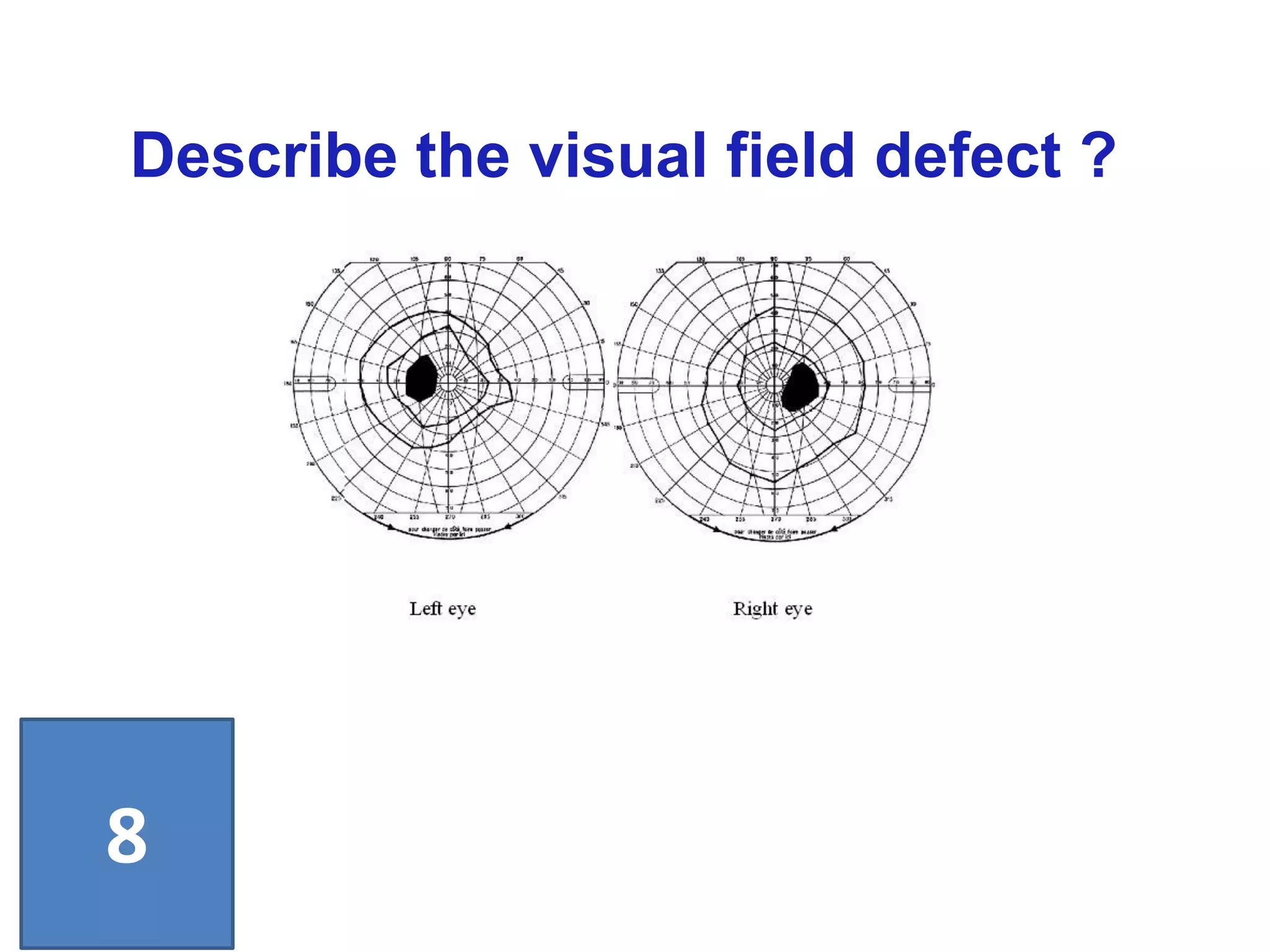 Describe the visual field defect ?
8
 