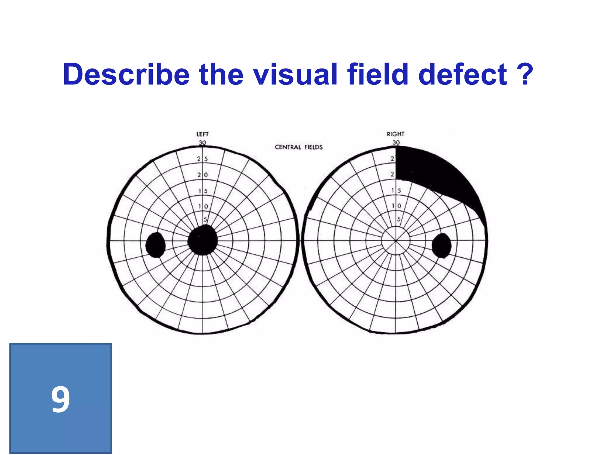 Describe the visual field defect ?
9
 
