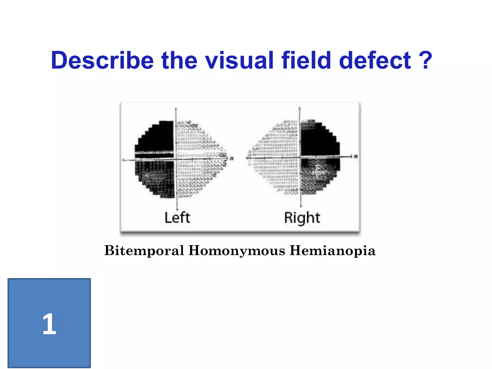 Bitemporal Homonymous Hemianopia
Describe the visual field defect ?
1
 