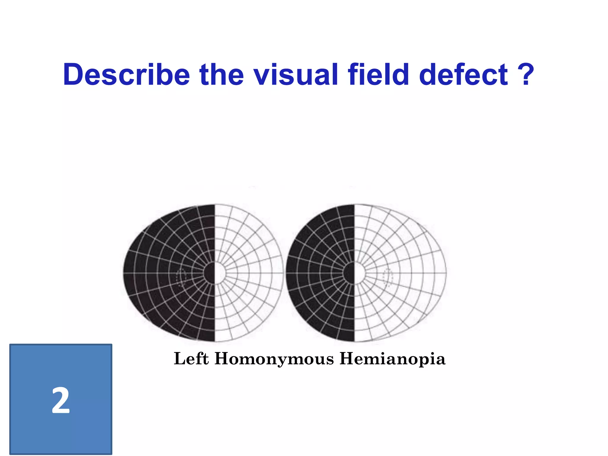 Describe the visual field defect ?
2
Left Homonymous Hemianopia
 