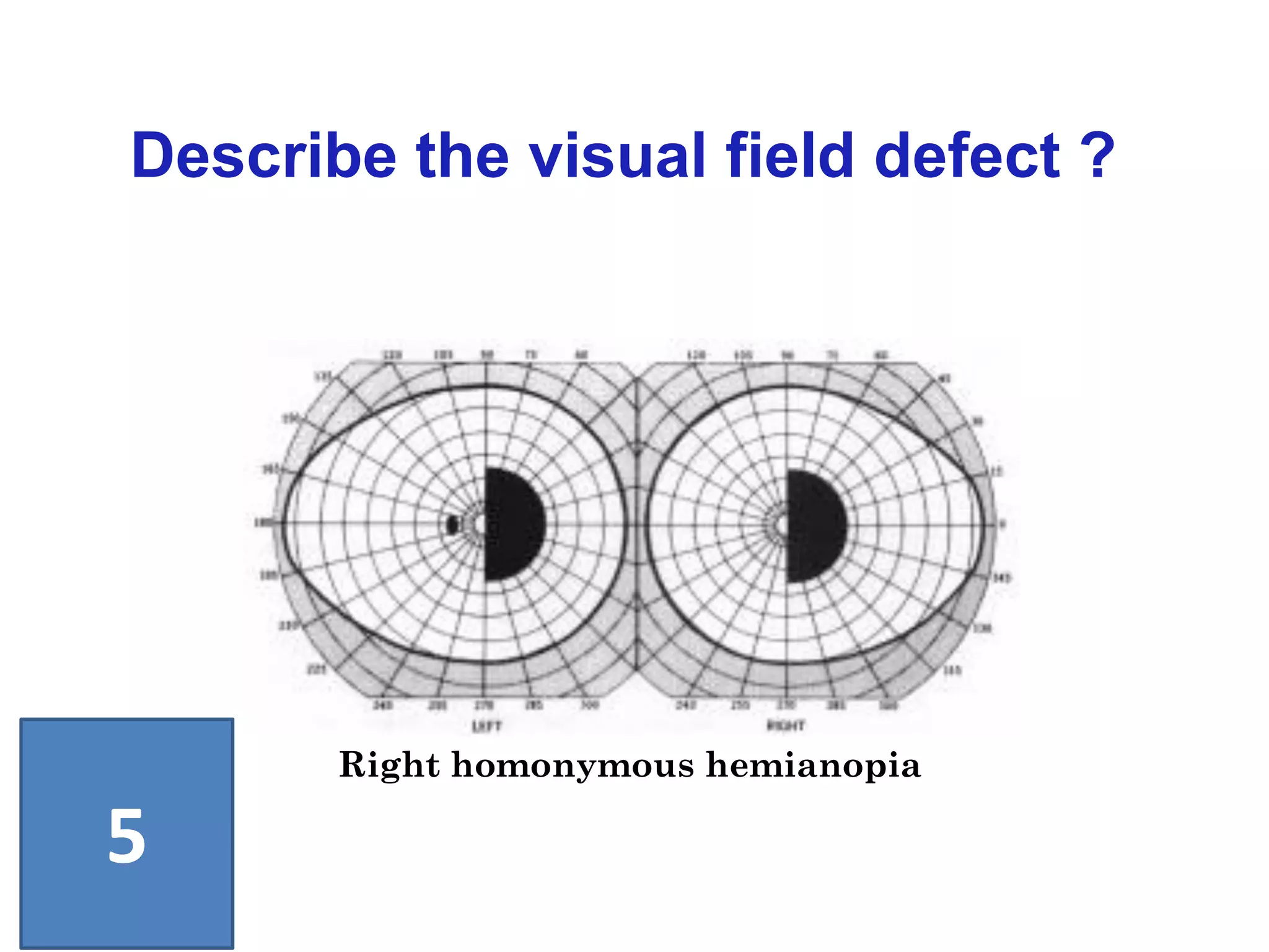 Describe the visual field defect ?
5
Right homonymous hemianopia
 