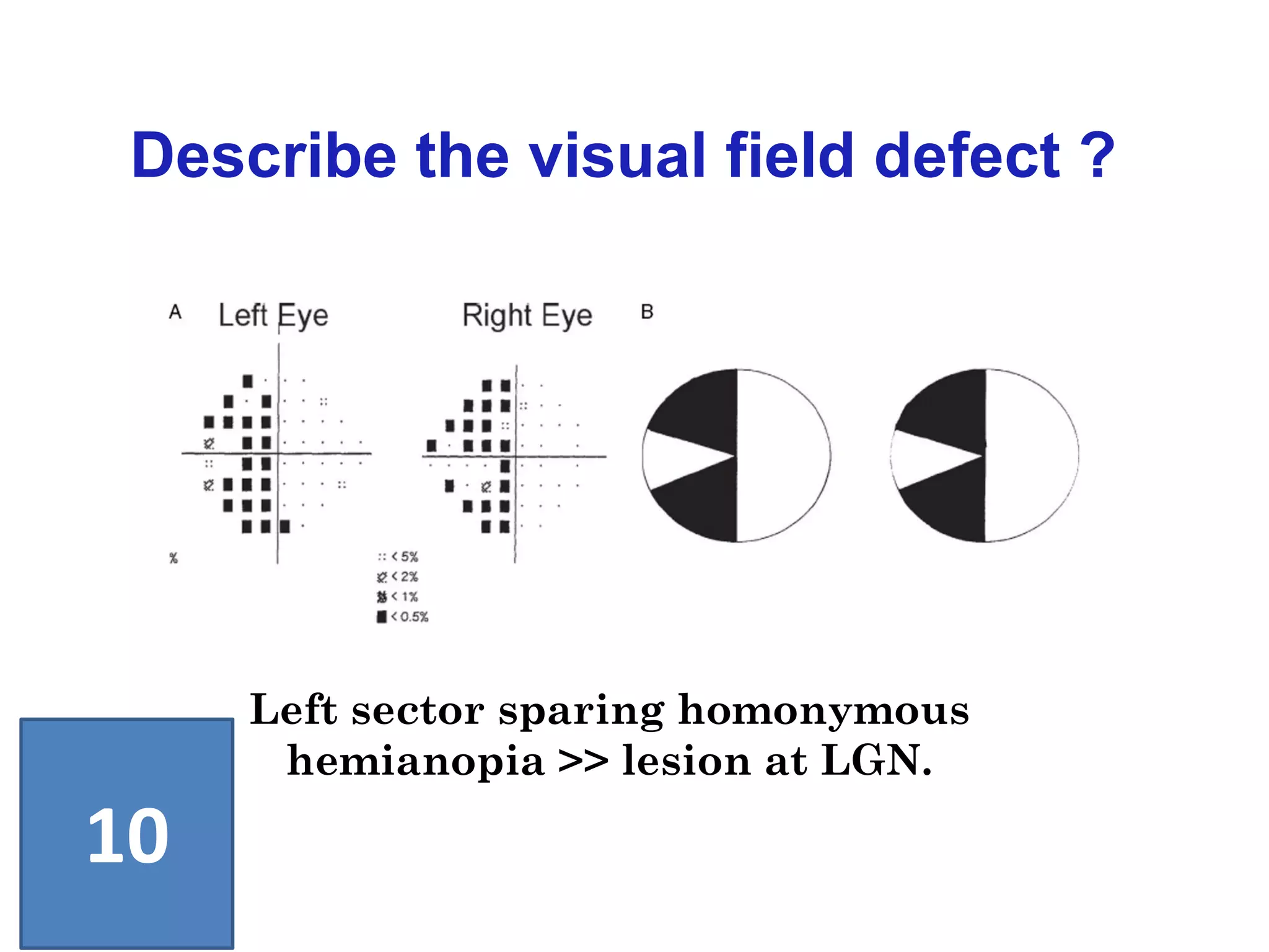 Left sector sparing homonymous
hemianopia >> lesion at LGN.
Describe the visual field defect ?
10
 