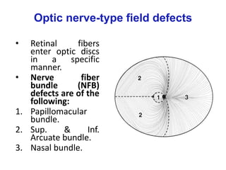 Optic nerve-type field defects
• Retinal fibers
enter optic discs
in a specific
manner.
• Nerve fiber
bundle (NFB)
defects are of the
following:
1. Papillomacular
bundle.
2. Sup. & Inf.
Arcuate bundle.
3. Nasal bundle.
 