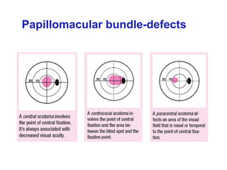 Papillomacular bundle-defects
 