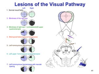 49
Lesions of the Visual Pathway
1. Normal visual fields
2. Blindness of the right eye
3. Blindness of right eye + contralateral left upper
quadrantanopia
4. Bitemporal heteronymous hemianopsia
5. Left homonymous hemianopsia
6. Left upper homonymous quadrantanopsia
7. Left homonymous hemianopsia with macular
sparing
RightLeft
 