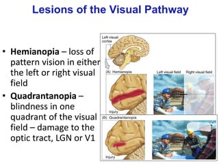 • Hemianopia – loss of
pattern vision in either
the left or right visual
field
• Quadrantanopia –
blindness in one
quadrant of the visual
field – damage to the
optic tract, LGN or V1
Lesions of the Visual Pathway
 