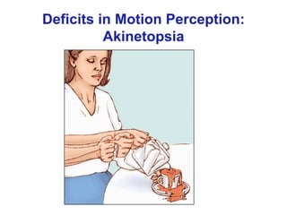 Deficits in Motion Perception:
Akinetopsia
 