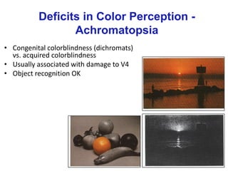 Deficits in Color Perception -
Achromatopsia
• Congenital colorblindness (dichromats)
vs. acquired colorblindness
• Usually associated with damage to V4
• Object recognition OK
 
